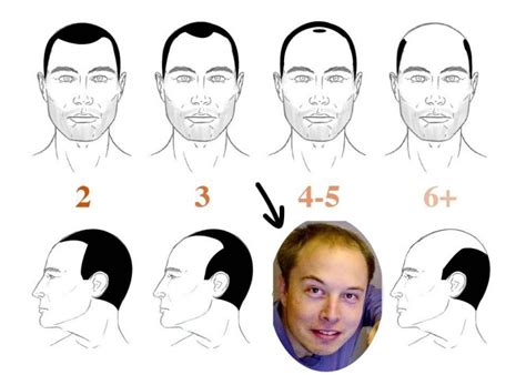 Elon Musk Hair Transplant History and Hair Analysis before and after