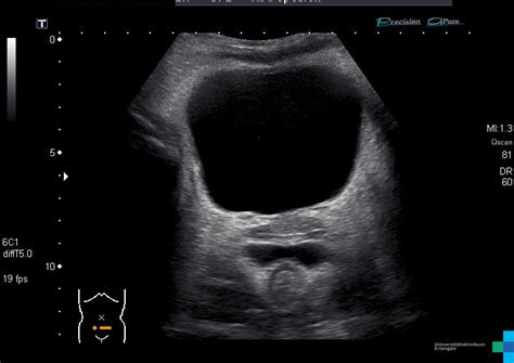 Douglas pouch – Atlas of Ultrasound