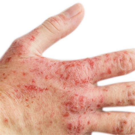 Feeling itchy this winter? You may have eczema, a condition that causes dry skin. It’s generally ...