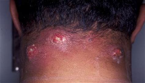 Furuncle Infection - Causes, Pictures, Symptoms, Diagnosis, Treatment.