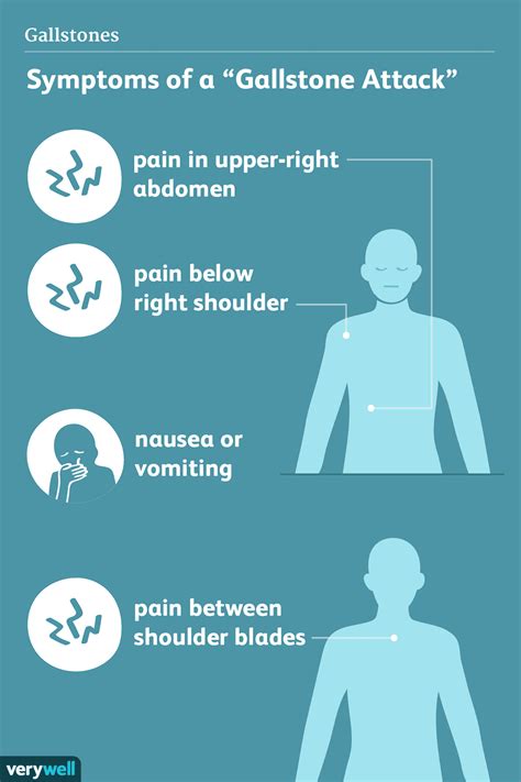 Gallstones: Signs, Symptoms, and Complications