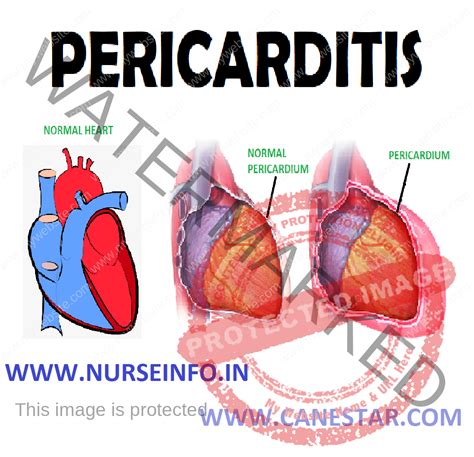 PERICARDITIS - Nurse Info