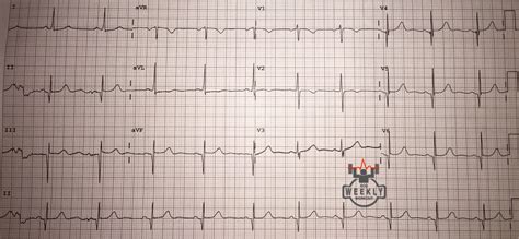 Syncope – Page 2 – ECG Weekly