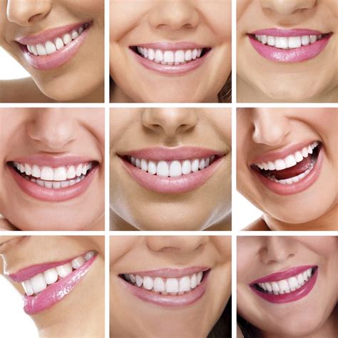 Which Veneer Is the Ideal Choice? | East Lake Advancing Dentistry