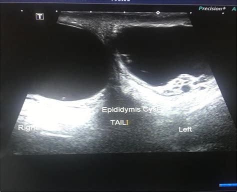 Bilateral epididymal cyst with spontaneous resolution - Mukendi - 2020 ...