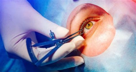 Cortical Cataract Surgery: Causes, Risks, Symptoms, Treatment