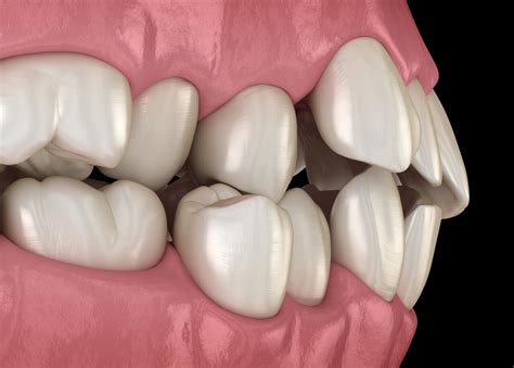 Causes and Treatment of Misaligned Teeth - Chicago Dental Implant