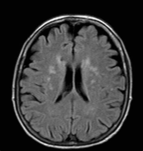 Chronic Microvascular Ischemic Changes - slideshare