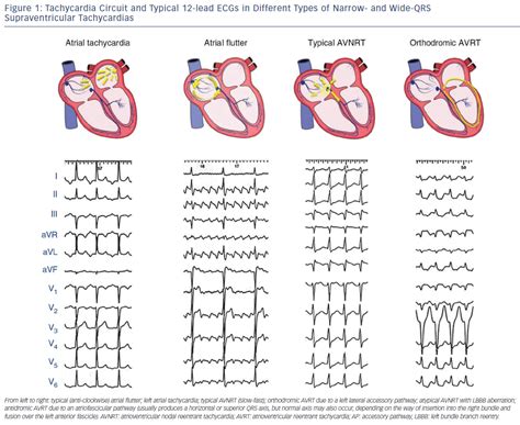 Figure 1: Tachycardia Circuit and Typical 12-lead ECGs in Different Types of Narrow- and Wide ...