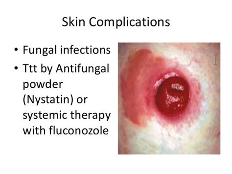 Cutaneous urinary Stoma