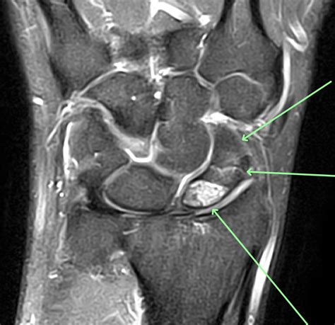 Scaphoid Fracture - Diagnosis - MRI Online