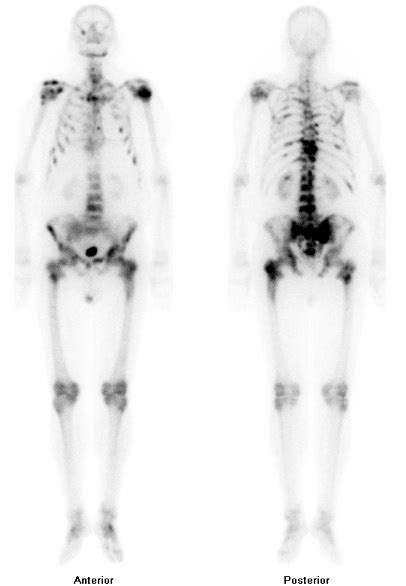 Prostate cancer other imaging findings - wikidoc