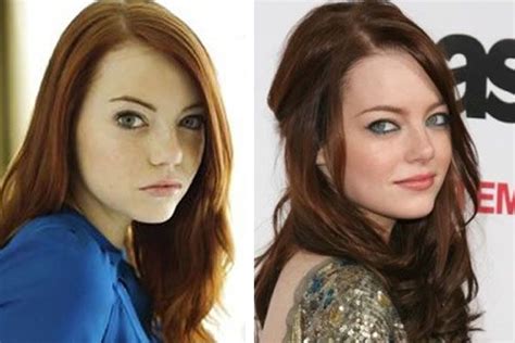 Celebrity emma stone nose job - http://www.starcelebsurgery.com/2014/02/celebrity-emma-stone ...