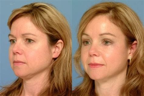 Procedure-for-Brow-Lift-before-and-after3 - Excellence Medical Cosmetic ...