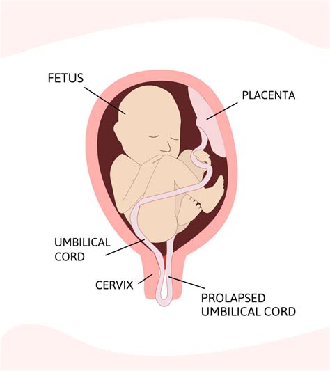 What Is Umbilical Cord Prolapse, Its Causes And Tips To Manage