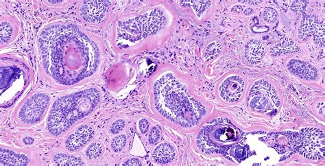 Squamous Cell Carcinoma Vs Basal Cell Carcinoma Histology