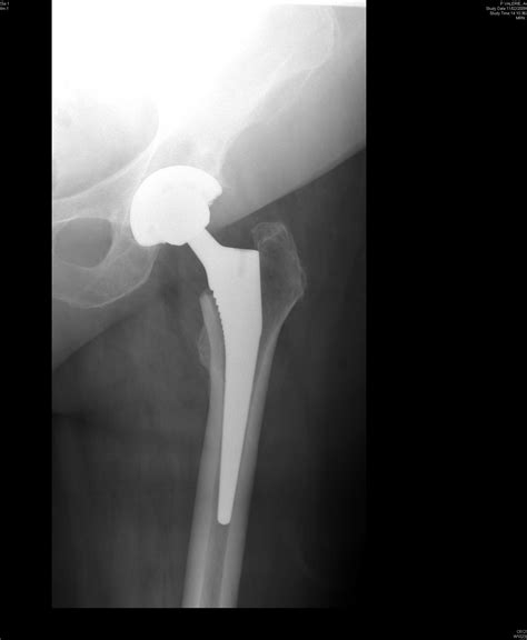 Arthroplasty, Replacement, Hip; Hip Prosthesis Implantation; Hip Replacement, Total