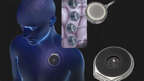 Neuralink competitor Paradromics gears up to test its brain implant on ...