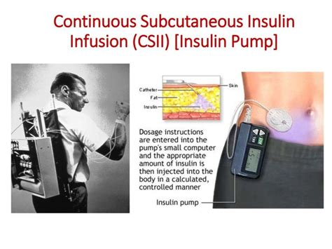 Reimbursement of Continuous Subcutaneous’ Insulin Infusion (CSII) Pump ...