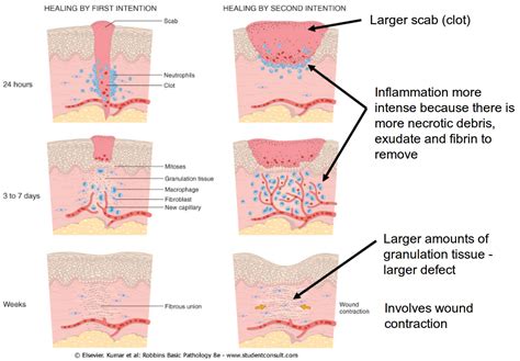 primary and secondary intent | Wound healing nursing, Wound healing, Nursing school tips