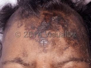 Dermatosis neglecta