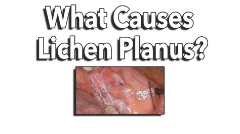 What is Oral Lichen Planus?