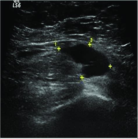 b: Ultrasound image of the same patient's right axillary region at ...