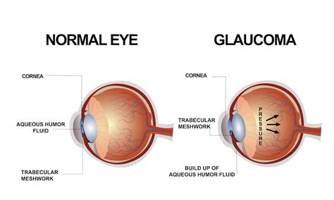 Treatment Of Glaucoma In Dogs | Kingsdale Animal Hospital