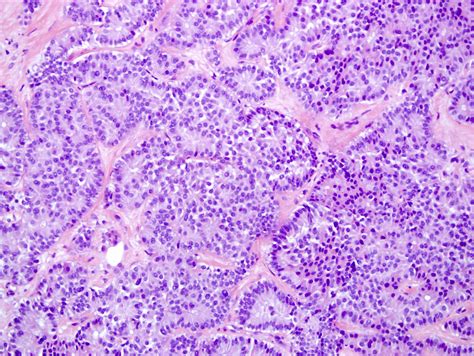 Pancreatic Islet Cell Tumor