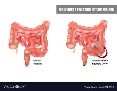 Volvulus sigmoid colon Royalty Free Vector Image