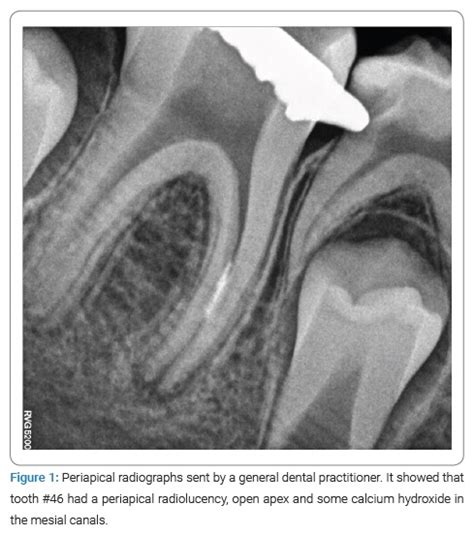 Treatment of a Partially Necrotic Molar Tooth by Applying Apexogenesis ...