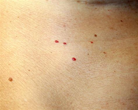 What causes red blood spots on my skin? - Quora