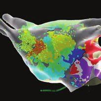 Still frame from the left atrial (modified anteroposterior view tilted... | Download Scientific ...