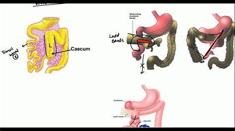 Volvulus Malrotation