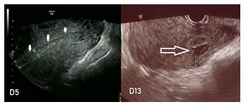 Clinical Complications Induced by Placental Site Subinvolution: Secondary-Type Hemorrhage after ...