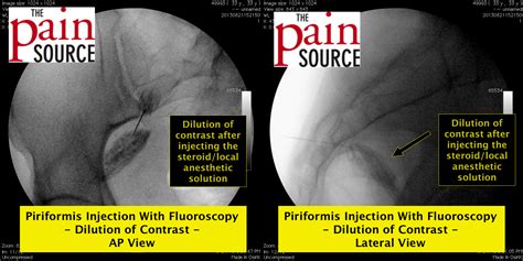 Piriformis Injection Landmarks