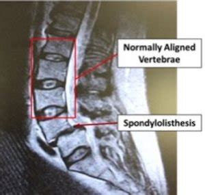 Spondylolisthesis - New Jersey - Centers for Neurosurgery, Spine, and Orthopedics