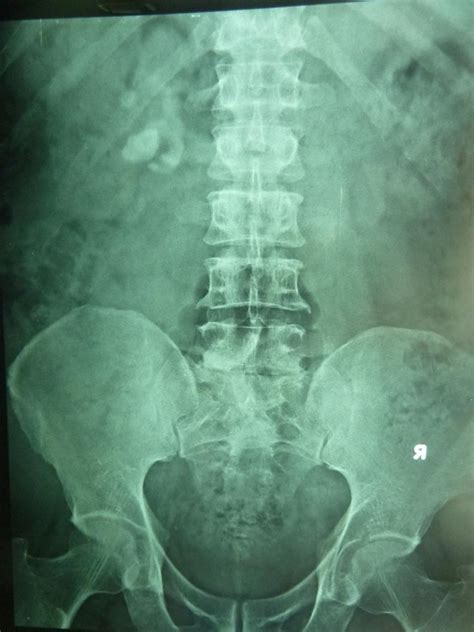 Staghorn kidney stones photos