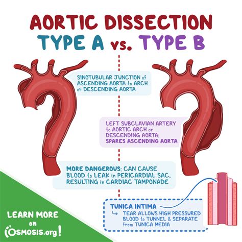 Osmosis - Aortic dissection is a tear of the aortic tunica... | Facebook