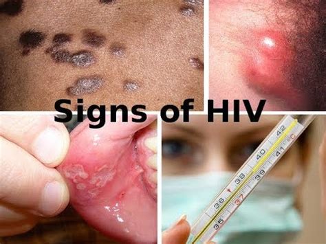 Symptoms and signs of HIV infection - YouTube