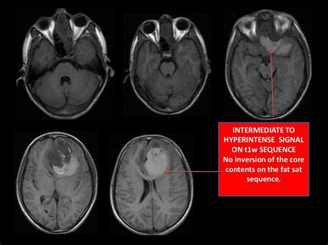 Olfactory neuroblastoma