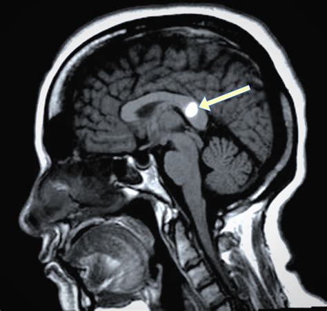 Cureus | Atypical Location of Intracerebral Hemorrhage in Moyamoya Disease