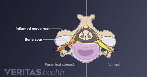 Cervical Radiculopathy Causes and Risk Factors