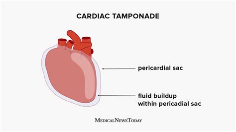 Cardiac Tamponade Symptoms