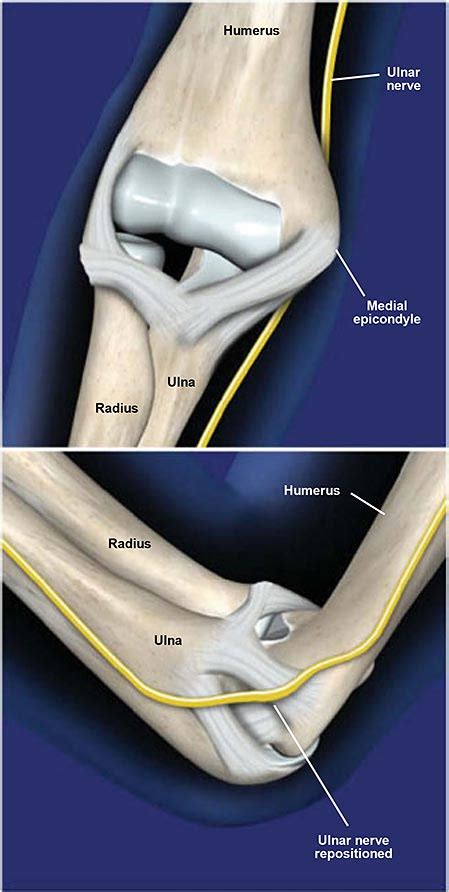 Ulnar Nerve Transposition at the Elbow | Central Coast Orthopedic Medical Group