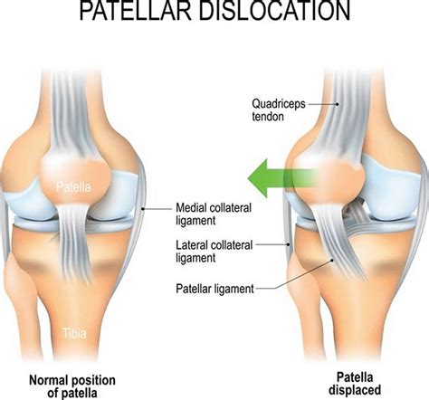 Patellar dislocation causes, symptoms, diagnosis, treatment & prognosis