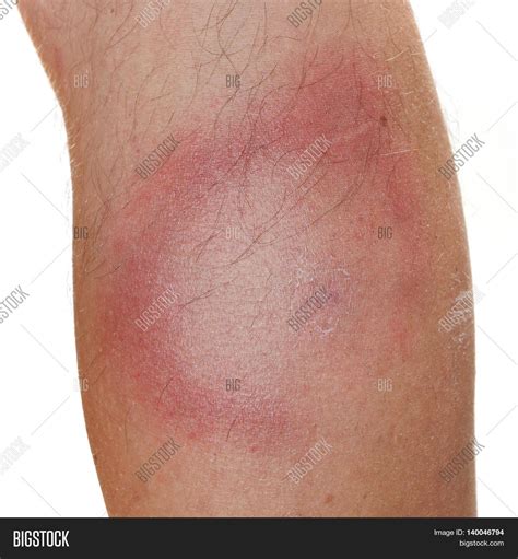 Erythema Migrans Rash Image & Photo (Free Trial) | Bigstock