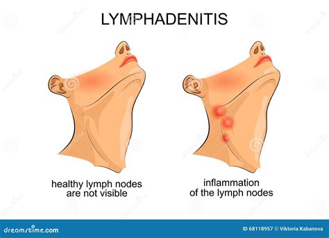 Lymphadenitis . Inflammation Of The Lymph Nodes Stock Photo - Image: 68118957