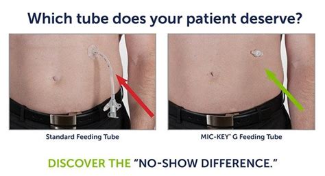 Mic, Feeding tube, Comparison