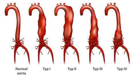 Abdominal Aortic Disease | Maryland Vascular Specialists